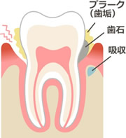 歯周病